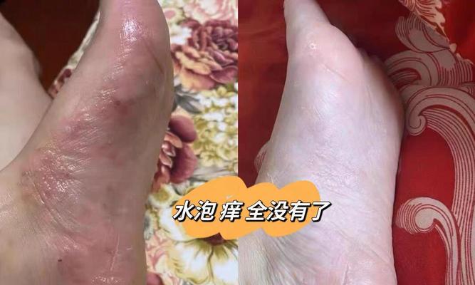 王者荣耀中“脚气”梗的含义是什么？